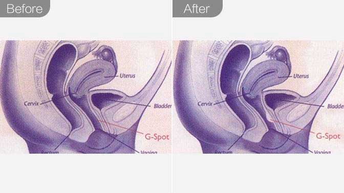 G点注射前后效果对比图