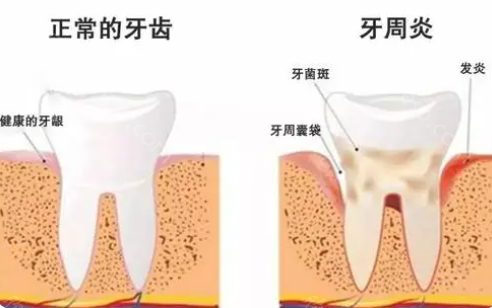 预防牙周病，荷马口腔提醒您一定要做好这些！