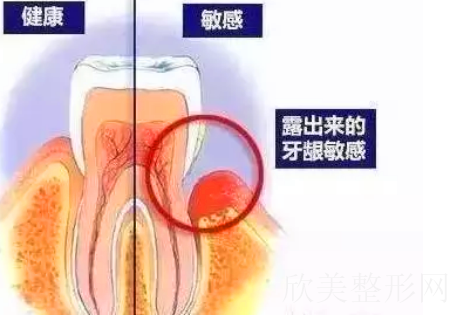 洗牙后悔一辈子