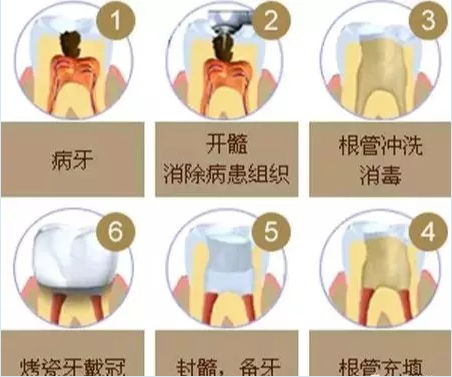 牙齿根管治疗的费用高吗 与哪些因素有关 欣美整形