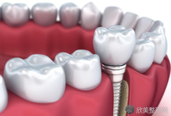 国内种牙多少钱一颗 2021年最新价格表大家看看吧 欣美整形