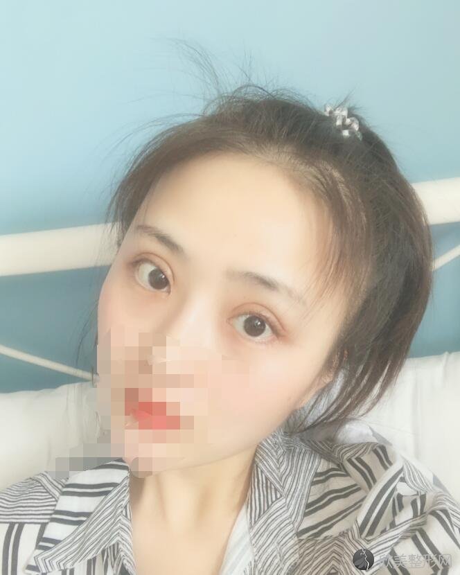 开内眼角术后30天