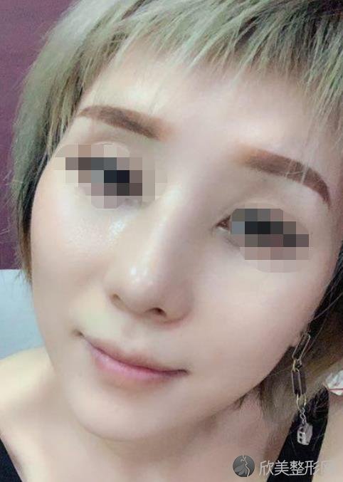 成都美极医疗美容门诊部黄华做埋线提升