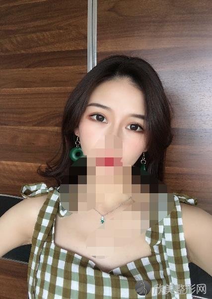 上海容妍医疗美容医院吴洪伟做面部填充之后