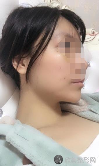 北京清木整形美容医院王宇医生做面部填充之后