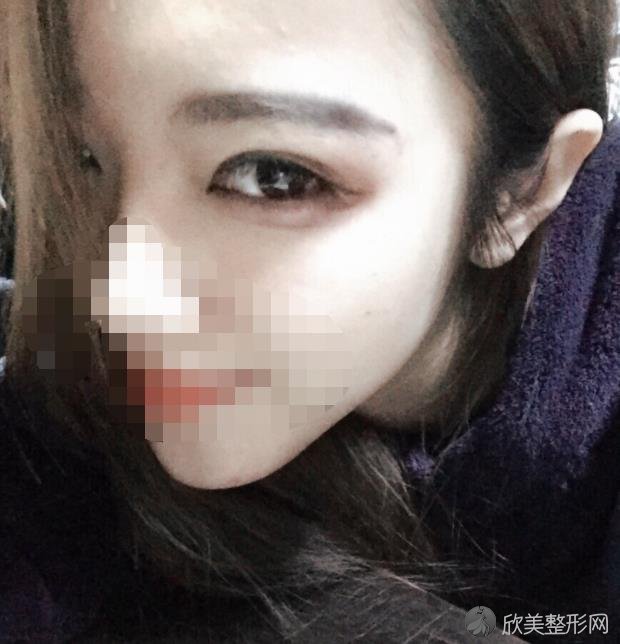 东莞西妃整形美容医院任家骠眼睛修复之后