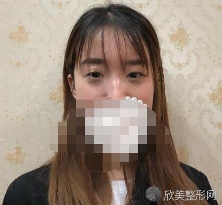 佛山梦露整形美容医院游万福医生做双眼皮之前