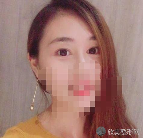 佛山梦露整形美容医院孙文娜医生去眼袋之后