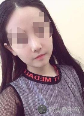 杭州格莱美医疗美容医院张医生隆鼻修复之后