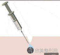 玻尿酸的副作用有哪些？术后出现副作用的几率大不大？