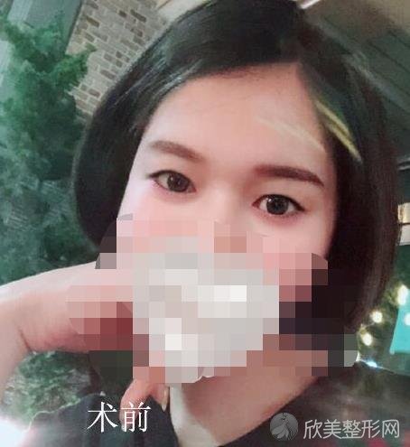 汪晓蕾医生做双眼皮之前