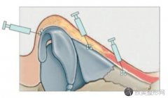 玻尿酸隆鼻效果如何？