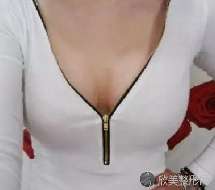 隆胸之后