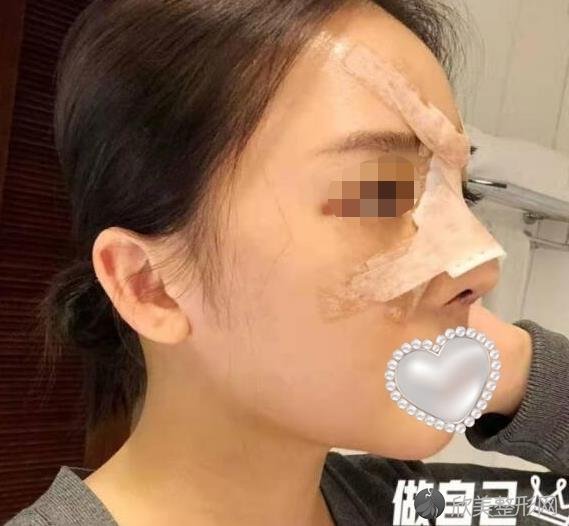 西安瑞丽斯整形美容做隆鼻之后