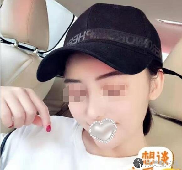 西安瑞丽斯整形美容做隆鼻之后