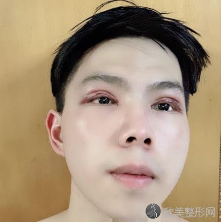 吉林省人民医院整形科怎么样？男士双眼皮案例手术恢复过程图一览