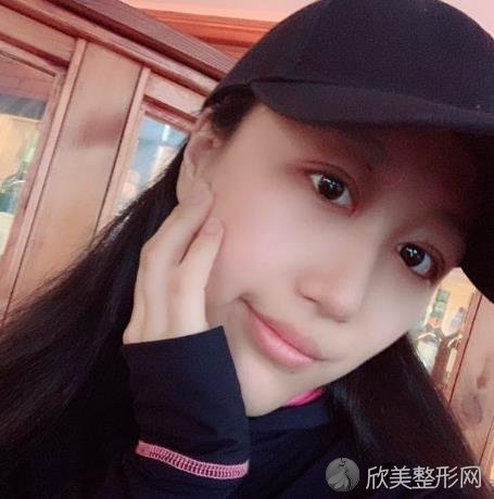 上海华美杨亚益做眼睛修复怎么样?附案例恢复效果+口碑价格一览