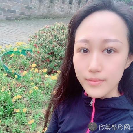 上海华美杨亚益做眼睛修复怎么样?附案例恢复效果+口碑价格一览