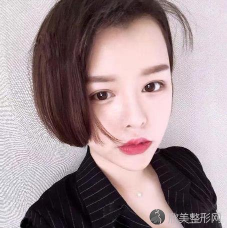 成都美雅娜廖连平做鼻子怎么样？附术后30天恢复效果图！