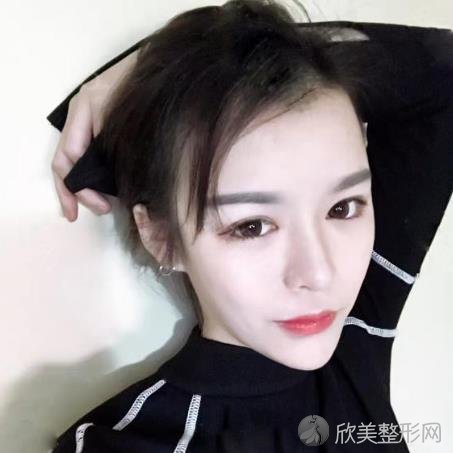 成都美雅娜廖连平做鼻子怎么样？附术后30天恢复效果图！