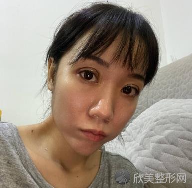 宁波艺镁整形医院怎么样？附双眼皮案例效果分享