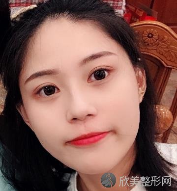 重庆晶肤双眼皮手术怎么样？30天后恢复效果对比图+较新价格表参考