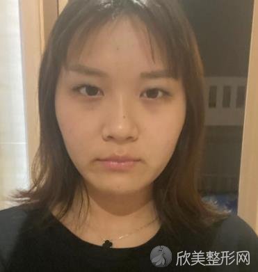 宜昌伊莱美整形医院双眼皮怎么样？医生介绍+案例分享