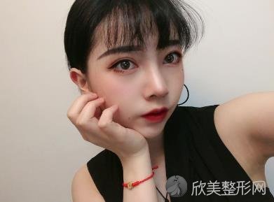 石家庄贵美人隆鼻手术效果怎么样？看看效果对比就知道