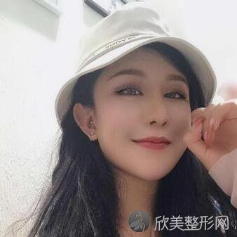 长沙安吉娜整形医院做的双眼皮效果怎么样？内附无痕双眼皮手术案例展示