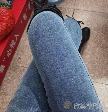 上海九院整形科大腿吸脂怎么样？效果好吗？内附效果对比图！