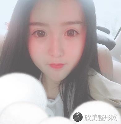 郑州美莱双眼皮术后三个月：你看看效果还会觉得花6800元起贵吗？