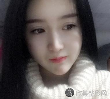 郑州美莱双眼皮术后三个月：你看看效果还会觉得花6800元起贵吗？