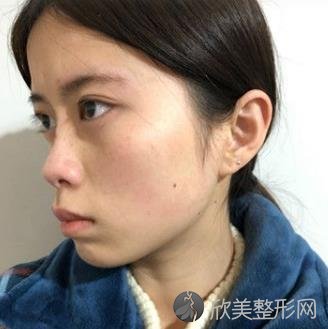 西安西京医院整形科隆鼻怎么样？案例证实医生技术和手术风格！