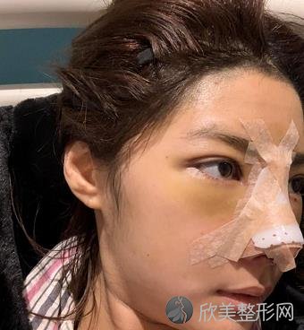 广州美莱隆鼻案例反馈，肋软骨隆鼻效果更好！