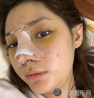 广州美莱隆鼻案例反馈，肋软骨隆鼻效果更好！