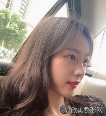 广州美莱罗延平医生做的隆鼻怎么样？内附隆鼻案例效果展示