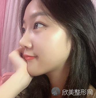 广州美莱罗延平医生做的隆鼻怎么样？内附隆鼻案例效果展示