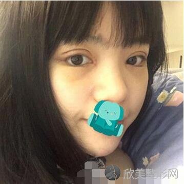 东莞康华医院整形美容中心做双眼皮如何？真人案例对比图发布