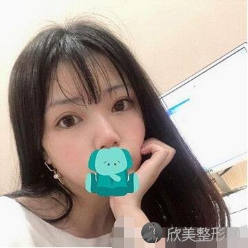 东莞康华医院整形美容中心做双眼皮如何？真人案例对比图发布