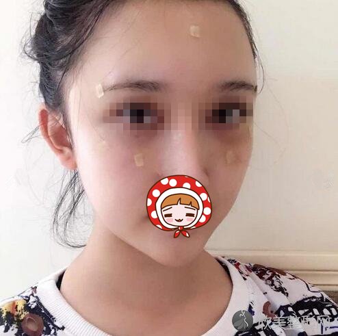 郑州集美刘德辉祛眼袋+自体脂肪填充案例 面部年轻一步逆袭