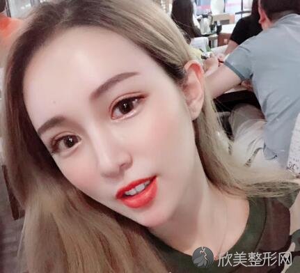 深圳港美医疗美容医院双眼皮案例