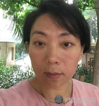 长春海茵整形美容去眼袋怎么样?附去眼袋前后对比图