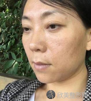 长春海茵整形美容去眼袋怎么样?附去眼袋前后对比图