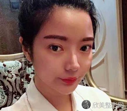 长沙美之峰医疗美容刘磊怎么样？双眼皮案例恢复效果照