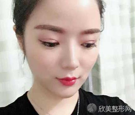 长沙美之峰医疗美容刘磊怎么样？双眼皮案例恢复效果照