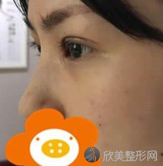 常州曙光医院割双眼皮到底正规吗?内附术后效果对比图