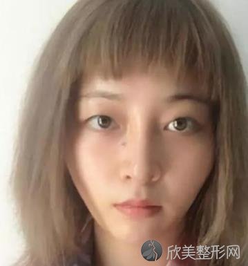 重庆西南医院做双眼皮怎么样？附真人案例效果图