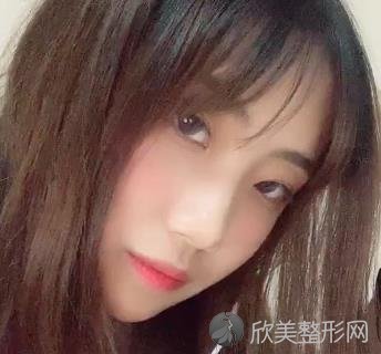 南昌二附院整形美容科割双眼皮案例，效果对比图