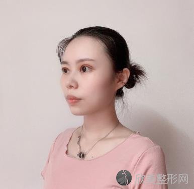 湖州曙光李禄增双眼皮技术怎么样？两个月后还是挺自然的