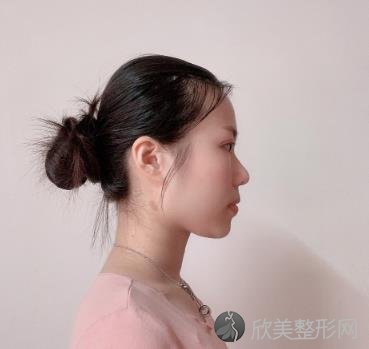 湖州曙光李禄增双眼皮技术怎么样？两个月后还是挺自然的